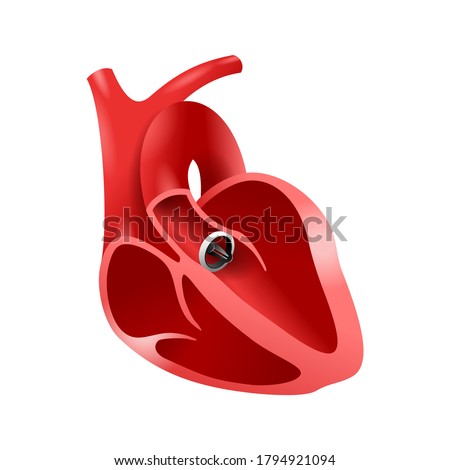 Artificial heart valve (aortic bileaflet) implanted into heart to replace a disfunctional native valve