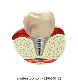 Artificial human tooth implant, cross section realistic view, vector illustration