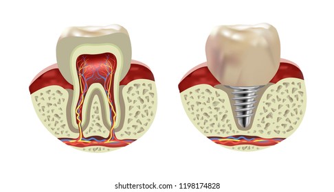 Artificial human tooth implant, cross section realistic view, vector illustration