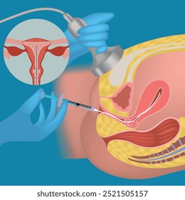 Inseminación artificial. Diagrama con procedimiento. Cartel médico, Vector