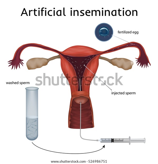Artificial insemination. The fertilized egg,\
washed, injected sperm, uterus, womb, syringe. Anatomy\
illustration. White\
background.