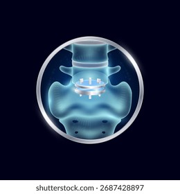 Artificial joints in circle frame label aluminum. Disc replacement or Prosthetic implant. Orthopedic technology surgery for treatment arthritis damaged cartilage. Medical product vector.