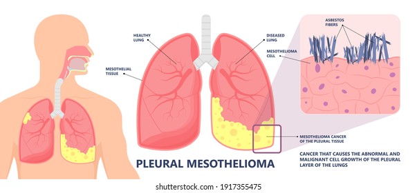 Asbestos Breath Chest Pain Testes Ascites Hydrocele Scrotum Swollen Difficulty Fluid Pleura Testicle Tunica Vaginalis Dust Tract Safe Safety Carcinogen Smoking Hazard Danger Tissue Toxic Silica Copd