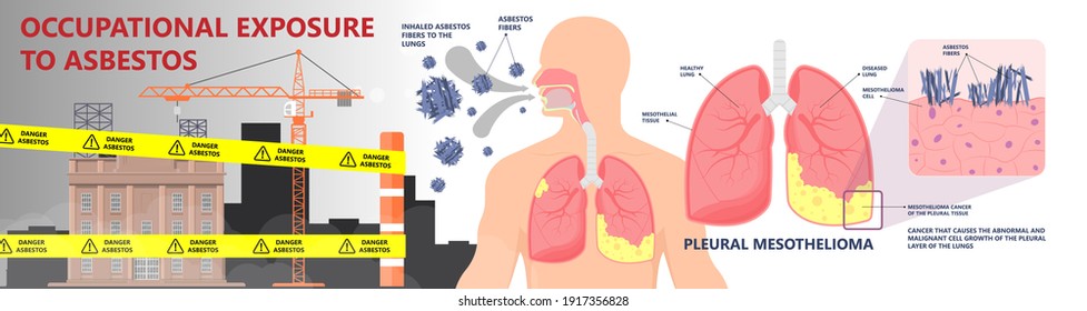 Asbestos Breath Chest Pain Testes Ascites Hydrocele Scrotum Swollen Difficulty Fluid Pleura Testicle Tunica Vaginalis Dust Tract Safe Safety Carcinogen Smoking Hazard Danger Tissue Toxic Silica Copd