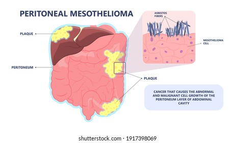 Asbestos Breath Chest Pain Testes Ascites Hydrocele Scrotum Swollen Difficulty Fluid Pleura Testicle Tunica Vaginalis Dust Tract Safe Safety Carcinogen Smoking Hazard Danger Tissue Toxic Silica Copd