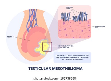 Asbestos Breath Chest Pain Testes Ascites Hydrocele Scrotum Swollen Difficulty Fluid Pleura Testicle Tunica Vaginalis Dust Tract Safe Safety Carcinogen Smoking Hazard Danger Tissue Toxic Silica Copd