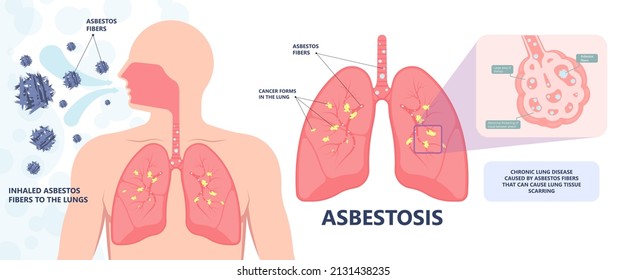 Asbestos Breath Chest Pain Testes Ascites Hydrocele Scrotum Swollen Difficulty Fluid Pleura Testicle Tunica Vaginalis Dust Tract Safe Safety Carcinogen Smoking Hazard Danger Tissue Toxic Silica Copd