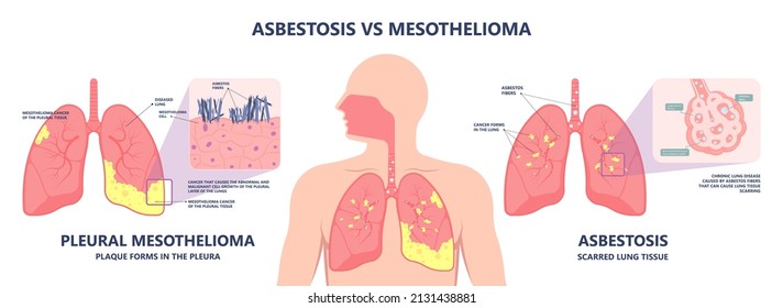 Asbestos Breath Chest Pain Testes Ascites Hydrocele Scrotum Swollen Difficulty Fluid Pleura Testicle Tunica Vaginalis Dust Tract Safe Safety Carcinogen Smoking Hazard Danger Tissue Toxic Silica Copd