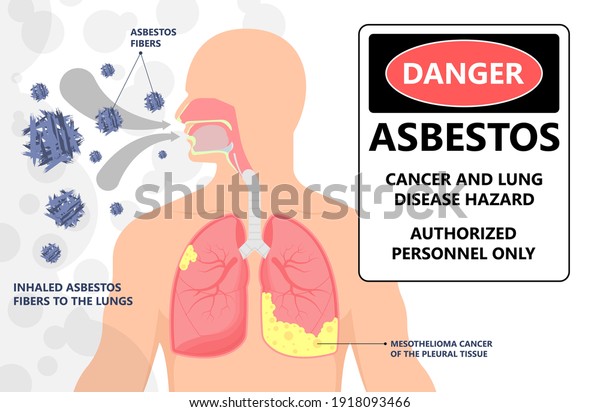 Asbestos breath chest pain testes ascites Hydrocele\
scrotum Swollen Difficulty fluid pleura testicle tunica vaginalis\
dust tract safe safety carcinogen smoking hazard danger tissue\
toxic silica copd