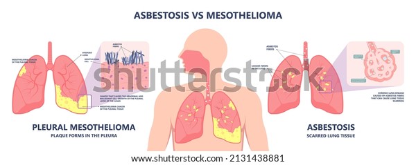 Asbestos breath chest pain testes ascites Hydrocele\
scrotum Swollen Difficulty fluid pleura testicle tunica vaginalis\
dust tract safe safety carcinogen smoking hazard danger tissue\
toxic silica copd