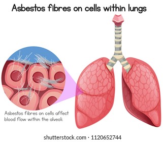 Asbestos Fibres On Cells Within Lungs Illustration