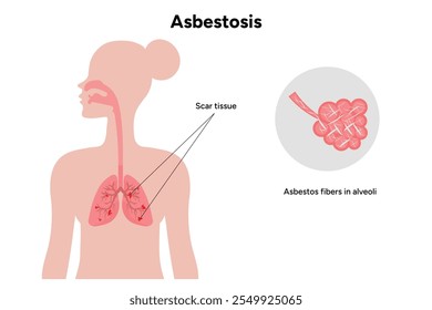 Asbestos related diseases lungs problem