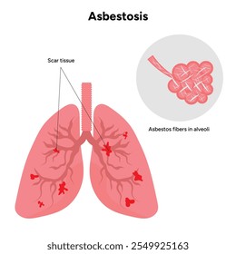 Asbestos related diseases lungs problem	