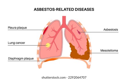 Asbestos related diseases. Pleura and diaphragm plaque, lung cancer, asbestosis, and mesothelioma tumor cells. Respiratory system illness. Shortness of breath, pain in chest flat vector illustration.