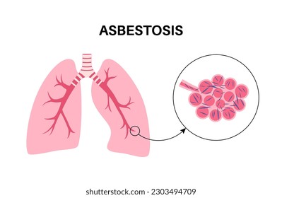 Asbestosis anatomical poster. Lung disease concept, asbestos fibers. Lung tissue scarring and shortness of breath, pain in chest. Breathing problem, illness of respiratory system vector illustration.