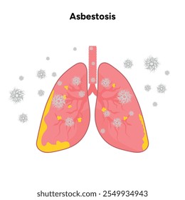 Asbestosis Enfermedades pulmonares, problemas pulmonares