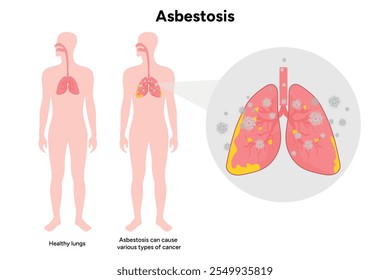 Asbestosis lungs diseases, lungs problem
