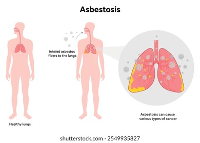 Asbestosis lungs diseases, lungs problem