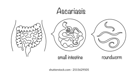 Ascariasis. A helminthic disease that develops when infected with roundworms. Parasites inside the human intestine. Disease of the gastrointestinal tract. Vector.