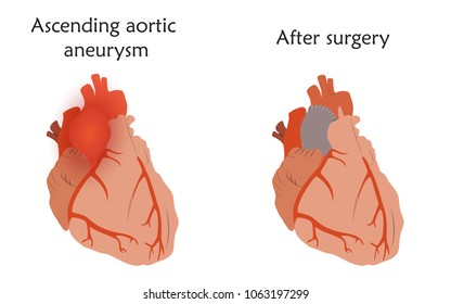 Ascending aortic aneurysm before and after repair. Tube graft and damaged heart muscle. Anatomy flat illustration. Colorful image, white background.