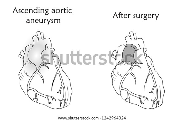 Ascending Aortic Aneurysm Before After Repair Stock Vector (Royalty ...