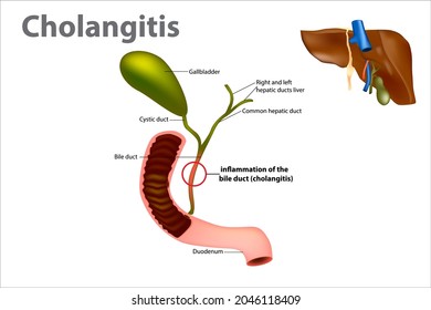 Ascending Cholangitis Known Acute Cholangitis Simply Stock Vector ...