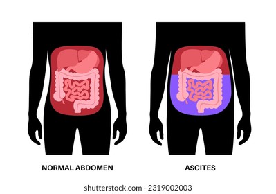 Ascita anatomía. Fluido en cavidad peritoneal. Distensión abdominal, dolor, hinchazón y náuseas. Presión en el vientre, órganos y vísceras. Tracto gastrointestinal. Ilustración vectorial de cavidad abdominopelvica