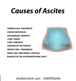 Ascites Free fluid in the abdominal cavity. Infographics. Vector illustration on isolated background.