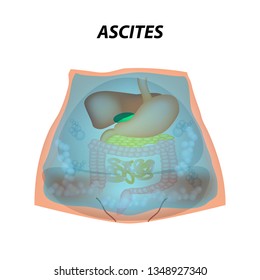 Ascites Free fluid in the abdominal cavity. Infographics. Vector illustration on isolated background.