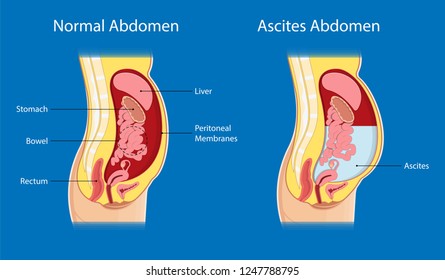 Ascites Paracentesis medical procedure diagnostic abdominal bacteria treatment therapy drainage