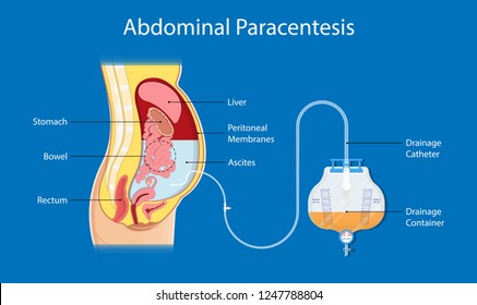 Ascites Paracentesis medical procedure diagnostic abdominal bacteria treatment therapy drainage
