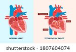 ASD VSD AFib exam hole leak pain TAVI TAVR based birth chest sinus treat angina damage Device murmur primum stroke repair septum ostium occlude surgery replace failure venosis venosus  problem