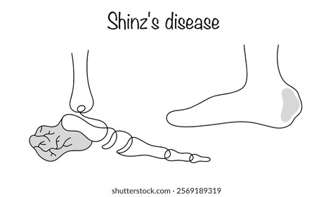 Aseptic necrosis of the calcaneal tuberosity. Drawn manifestation of the disease. A simple black and white illustration on a medical theme. Shinz's disease.