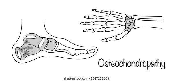 Necrosis aséptica del hueso canceroso, que ocurre de forma crónica y da complicaciones en forma de microfracturas. Osteocondropatía de los huesos del pie y la mano. Ilustración vectorial.