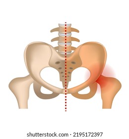 aseptic necrosis. Hip bone with damaged femoral head. Infographic with axis of symmetry. Vector illustration