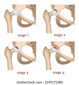 necrosis aséptica. Etapas de destrucción de la cabeza femoral. Afiche médico. Ilustración del vector