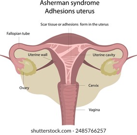 Asherman syndrome . Adhesions uterus.
Scar tissue or adhesions form in the uterus. Pathologies of female genital organs.