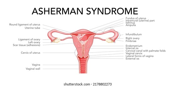 Asherman Syndrome Female Reproductive System Scar Tissue Adhesions In Uterus Diagram With Inscriptions. Front View In A Cut. Human Anatomy Internal Organs Location Scheme, Cervix Ovary Flat Style Icon