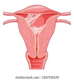 Asherman syndrome Female reproductive system scar tissue adhesions in uterus. Front view in a cut. Human anatomy internal organs location scheme, cervix, ovary, fallopian tube flat style icon