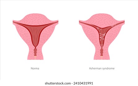 Asherman syndrome female reproductive system. Cross section of uterus with ashesions. Scar tissue in uterine cavity and normal healthy organ.