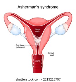 Asherman's syndrome. Cross section of uterine with adhesions. scar tissue in the uterine cavity. Intrauterine synechiae. Problems of infertility. Female reproductive system. Vector poster