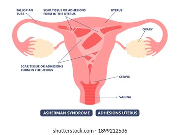 Asherman's Uterus Scar Tissue Cervix Wall Pelvic Pain Trauma And Genital Tube Cramps Abnormal Injury Deposit Tract Cancer HSG No Period Ovary PCOS Polyp Fibroid Menstruation Cycle Loss