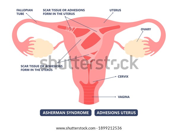 Asherman's
uterus scar tissue cervix wall pelvic pain trauma and genital tube
cramps abnormal injury deposit tract cancer HSG no period ovary
PCOS polyp fibroid menstruation cycle
loss