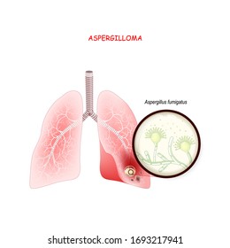 Aspergilloma is a clump of mold which exists in a body cavity. Human's lungs with fungi. Close up of Aspergillus fumigatus. Vector illustration for medical use