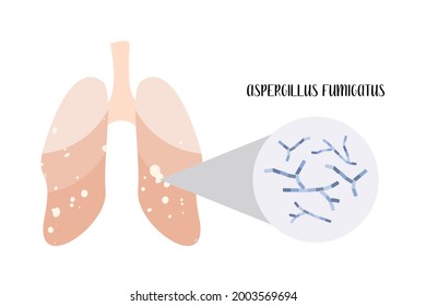 Aspergillus fumigatus, Aspergillus niger, Aspergilloma. Human lungs with fungal ball, black mold. Respiratory tract infections. Microbiology. Vector flat illustration