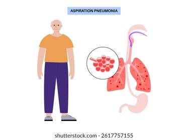 Aspiration pneumonia in an elderly person. Blockage of the airways by fluids or food, inflammation and infection of the lungs. Swallowing problems, respiratory system illness flat vector illustration