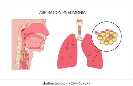 Aspiration pneumonia poster. Food particles and liquid entering the trachea instead of the esophagus. Inflammation in the lower lung lobe. Arrows indicate misdirection of swallowed content flat vector