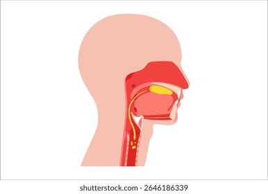 Aspiration pneumonia poster. Food particles and liquid entering the trachea instead of the esophagus. Inflammation in the lower lung lobe. Arrows indicate misdirection of swallowed content flat vector