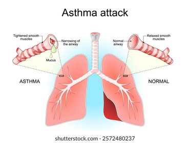 Asthma attack. Lungs, bronchi and airways. Close-up of a cross-section of a normal airway and Narrowed of bronchioles with Mucus. Asthma symptoms. Tightened smooth muscles during of  bronchospasms