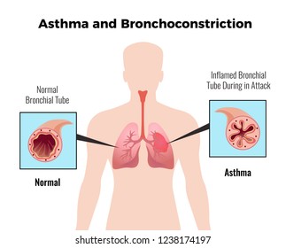 Asthma attack medical educative chart poster with depiction of normal and inflamed bronchial tube flat vector illustration